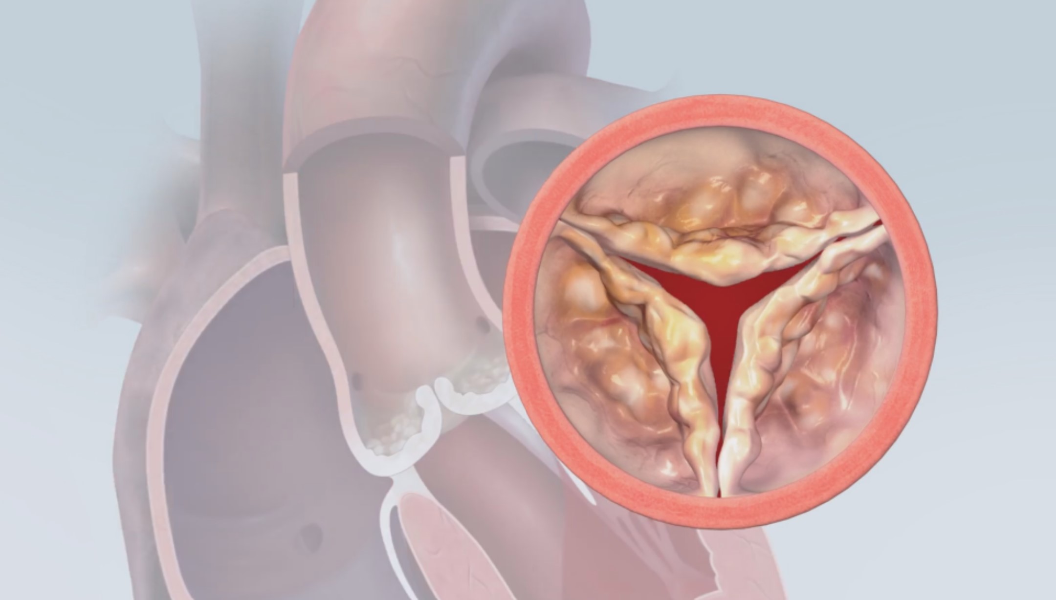 Aort stenozu